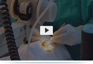 Sutureless / Near Painless
Pterygium Surgery Videos
